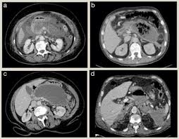 Check spelling or type a new query. Acute Pancreatitis Surgery Oxford International Edition