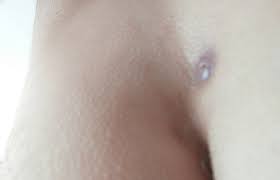 Steissbeinfistel Entstehung Symptome Behandlungsmoglichkeiten Steissbeinfistel Erfahrung De