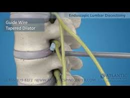Atlantic Spine Center Offers Expertise In Endoscopic Spine Surgery A Minimally Invasive Surgery Providing Smalle Health Knowledge Spinal Surgery Cervical Disc