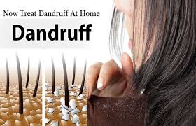 10 Home Remedies To Treat Dandruff At Home Such Tv