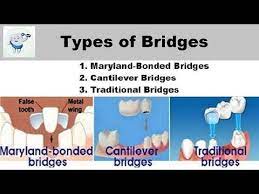 Types Of Dental Bridges Youtube Dental Bridge Cost Dental Bridge Dental
