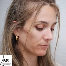 Miguel Angel Melchor Diaz (@dr.melchor.rinoplastia) • Instagram photos and  videos