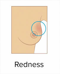 Stages of breast cancer it not only depends on the type of breast cancer or where it first presents itself; These 9 Pics Showing The Common Signs Of Breast Cancer Are A Must See For Everyone Bored Panda