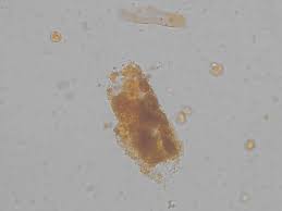 Image result for Urinary Cast