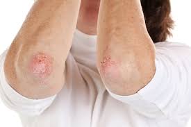 Image result for koebner phenomenon psoriasis