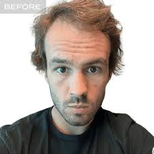 Female Hair Transplant NYC by Nova Medical Hair Transplant