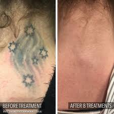 Presently laser tattoo removal is one of the most effective means of fading the appearance of a tattoo; Images Tailored Tattoo Removal Melbourne