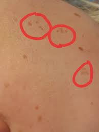While all hair removal creams will get rid of unwanted hair, some are infused with calming ingredients that leave skin soft and moisturized. Just Burned My Face With Hair Removal Cream Mumsnet