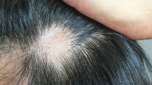 Coronavirus Que Causa Y Como Tratar La Caida Del Cabello Que Afecta A Uno De Cada Cuatro Infectados Bbc News Mundo