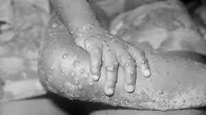 Monkeypox is a viral disease that causes symptoms such as fever, sweating, and a rash with papules and pustules on the face and chest. Uk Patient Diagnosed With Monkeypox Bbc News