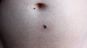 Ingrown armpit hair from waxing or shaving if you get razor bumps when you're shaving, it's because the skin of the underarms is quite sensitive. Ingrown Hair Removal Gross Videos Armpit Face Stomach