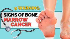Bone pain is the most common symptom for this type of cancer. 9 Warning Signs Of Bone Marrow Cancer Youtube