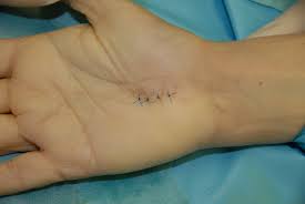 We did not find results for: Heidemann Hand Und Ellenbogenchirurgie In Hurth Karpaltunnelsyndrom