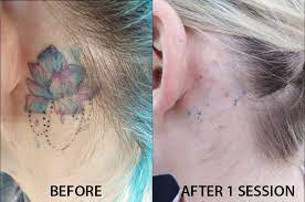 A tattoo's cost depends on the size, complexity of the design, and demand for the artist who is creating it. Laser Tattoo Removal The Latest In Effective Tattoo Removal