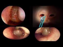Click on any photo to see larger images and other views. How To Get Rid Of Nose Polyps Sinus Polyps Naturally At Home Without Surgery Youtube Sinus Polyps Sinusitis Essential Oil For Liver