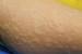 Ingrown Hair Pimple On Leg