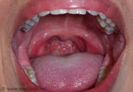 This is because often people confuse tonsil stones or tonsillitis as tonsil cysts. Sore Throat Symptom Evaluation