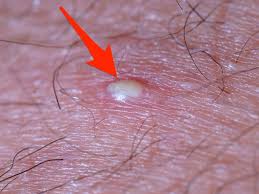 Aspirin is used to minimize the pain and also to get rid of the ingrown hair. How To Get Rid Of Ingrown Hairs