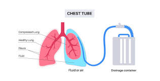 Image result for Small Caliber Chest Tube