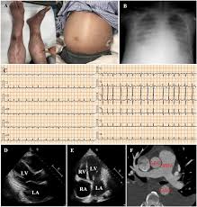 Image result for Edema Exam