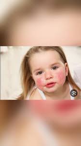 #مـتـابـعـات, التحسس الغدائي, د زينب سعيد أبودينة Dr.Zaineb Saied Abodenna 