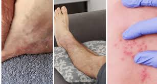 Ketika anda merasakan tumit kaki sakit, sebaiknya jangan paksakan untuk berakivitas. Tumit Kaki Kerap Sakit Ada Kaitan Dengan Masalah Batin Anda Maskulin