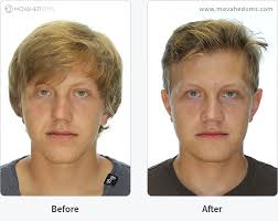 Does blue shield cover jaw surgery. Double Jaw Surgery Before And After Love Meme