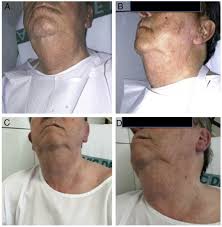 Image result for Sialoadenitis