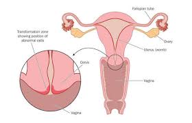 It's often referred to as the neck of the womb or the entrance of the womb. Cervical Cancer Causes Symptoms Treatment Clicks Health Hub