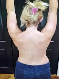 48.2 how long does it take to do these things? Leading The Way In The Treatment Of Scapula Winging