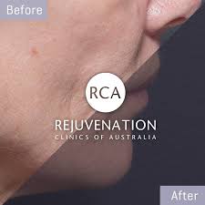 Then, you can pair it with frowning while correspondingly moving head. How To Get Rid Of Saggy Jowls