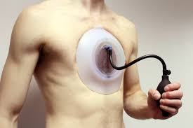 Image result for Pectus Excavatum
