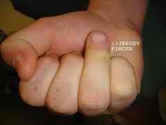 A Jersey Finger Is An Injury To The Fdp Tendon Of The Finger The Flexor Tendon Pulls The Finger Down Into The Hand Therapy Occupational Therapist Self Massage
