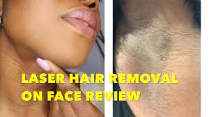 Laser hair removal can be done safely in people of color. Laser Hair Removal For A Black Girl Does It Work Youtube
