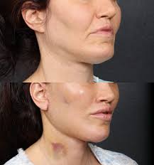Our patient is a few days post-surgery. This secondary facelift procedure  follows an initial surgery not performed by Dr. Sozer. In this procedure,  Dr. Sozer conducted a facelift, neck lift, and replaced
