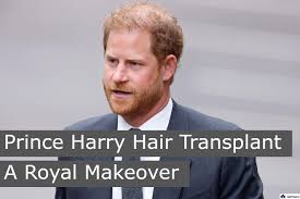 Prince Harry Hair Transplant