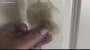 Hair loss is often distressing and can have a significant effect on the patient's quality of life. Some People Dealing With Hair Loss Months After Having Covid 19 Wtsp Com