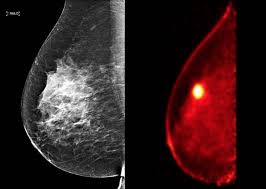 Pet scans are sometimes used to help plan. Breast Pet Scan Breast360 Org The American Society Of Breast Surgeons Foundation