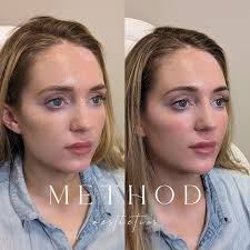 Balancing this beautiful patients face with some chin + cheek filler 💉  Injections and facial balancing don't have to be dramatic, in fact the  reason it's important to treat the face as