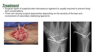 Image result for Scapholunate Dislocation