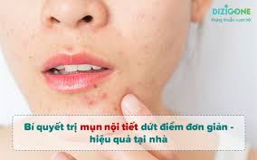 Bí quyết trị mụn nội tiết dứt điểm đơn giản - hiệu quả tại nhà - Dizigone -  Kháng khuẩn vượt trội
