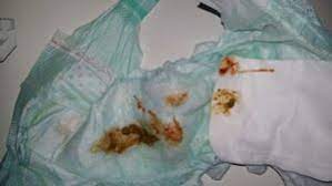 Blut Im Stuhl Bei Baby 5 Monate Forum Baby Urbia De