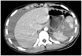 Image result for PECARN Pediatric Intra-Abdominal Injury Algorithm
