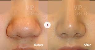 Different types of noses front view. Nose Surgery By Type Vip Plastic Surgery Korea
