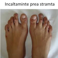 Scapa de bataturi cu aceste leacuri batranesti: Bataturile Piciorului Cauze Si Tratament