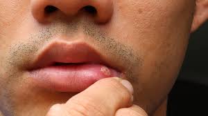 Image result for oral thrush symptoms roof of the mouth