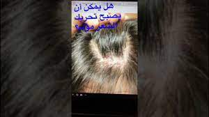 الآم الشعرة هل ممكن أن يصبح تحريك الشعر مؤلم youtube