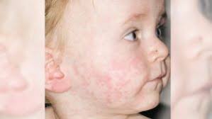 Image result for red rash face