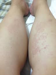 產後出紅疹｜懷孕大小事板｜媽咪愛