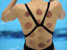 Maybe you would like to learn more about one of these? Rio 2016 What Is Cupping And Why Are Olympic Athletes Doing It The Independent The Independent